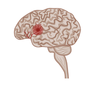 The red area represents a blood clot blocking a blood vessel and causing a stroke