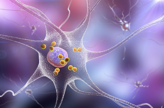 small spheres represent Lewy bodies inside a single nerve cell